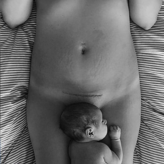 Mom and new born after caesarean section